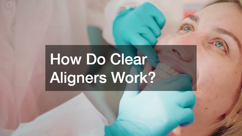 How Do Clear Aligners Work?