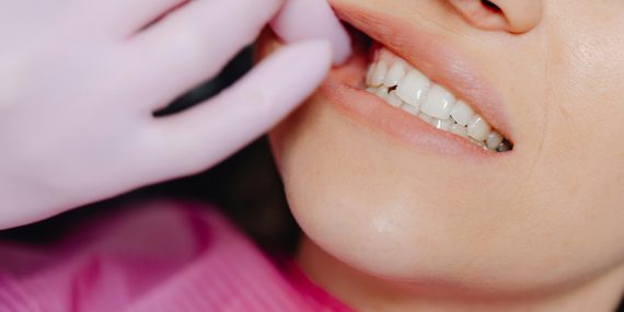 does everyone have wisdom teeth